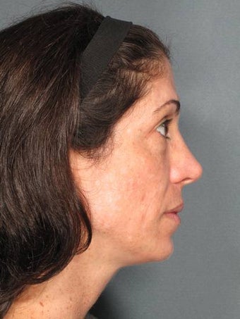 Premier Perfecting Peel