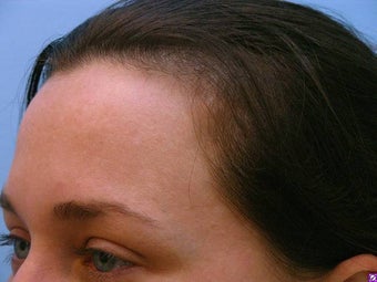 Melasma Treatment