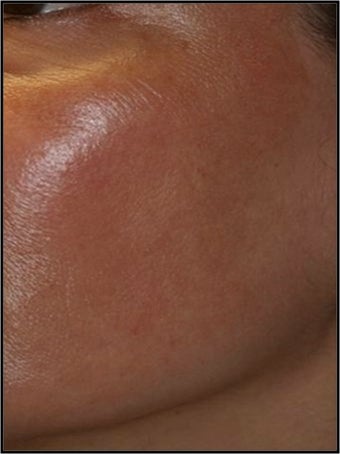 Fraxel - Melasma