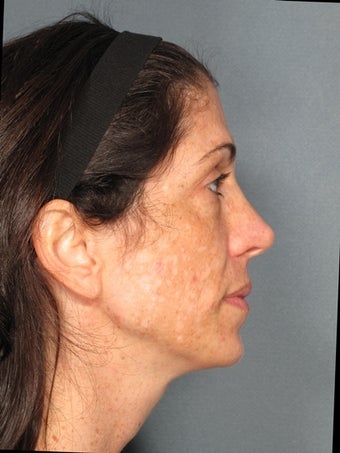 Premier Perfecting Peel
