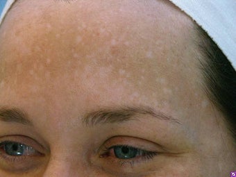 Melasma Treatment
