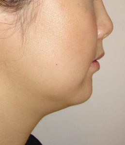 Mesotherapy for under chin