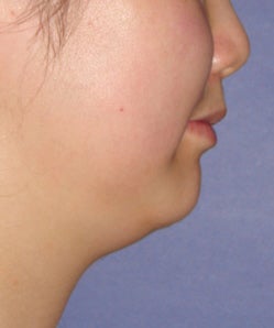 Mesotherapy for under chin