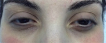 PRP (platelet rich plasma)
