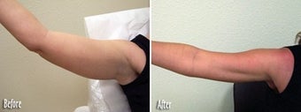 Mesotherapy to upper arms