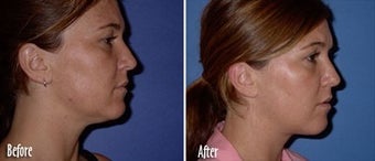 Mesotherapy to chin and jaw line