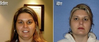 Mesotherapy to reduce double chin