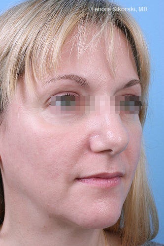 Fractional CO2 Laser Resurfacing