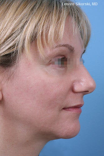 Fractional CO2 Laser Resurfacing 