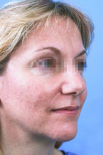 Fractional CO2 Laser Resurfacing