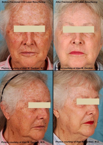 MiXto Laser Resurfacing 