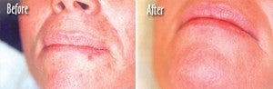  Microdermabrasion Chin and Mouth