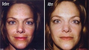  Microderm full face Before and After