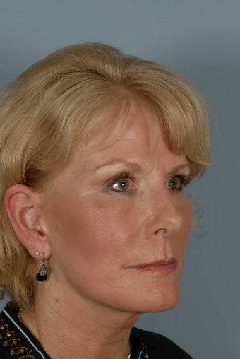 Qt Mini facelift with laser skin resurfacing