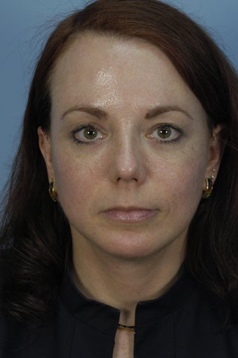 Qt Mini Facelift, Endoscopic browlift, Chin Augmentation and Sub Mental liposuction