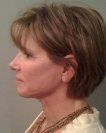 Laser Mini Facelift