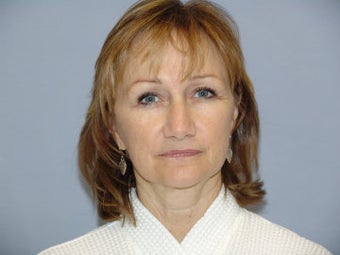 Mini Face lift