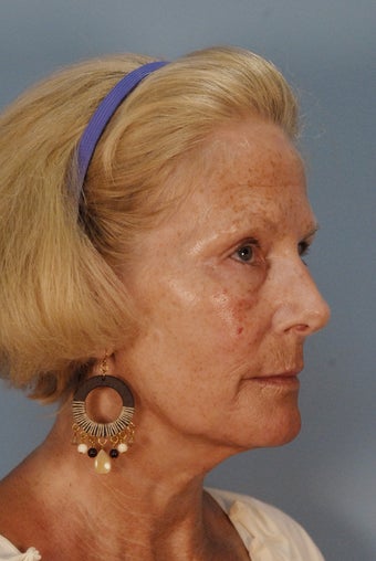Qt Mini facelift with laser skin resurfacing