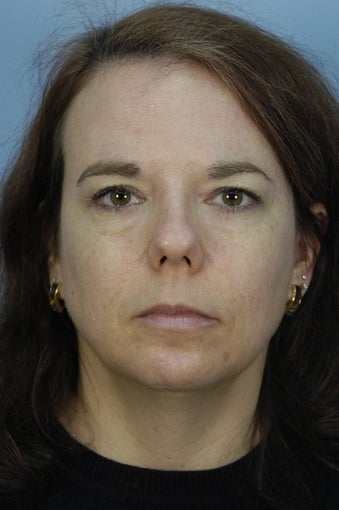 Qt Mini Facelift, Endoscopic browlift, Chin Augmentation and Sub Mental liposuction