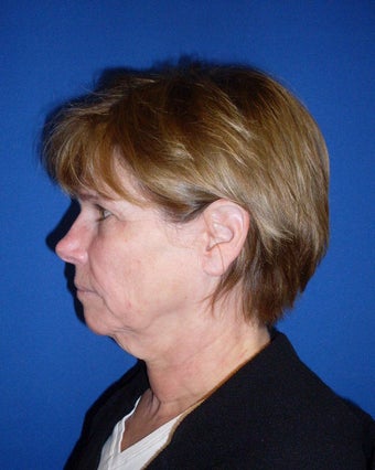 Laser Mini Facelift