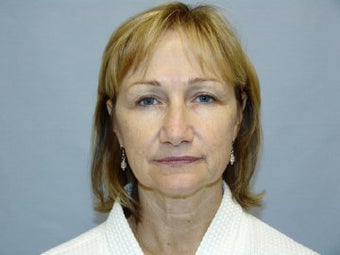 Mini Face lift