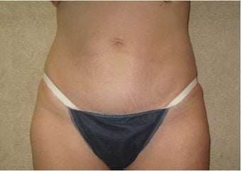 Abdominoplasty