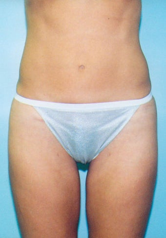 Mini-Tummy Tuck with Liposuction