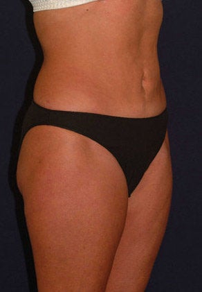 Tummy Tuck / Abdominoplasty
