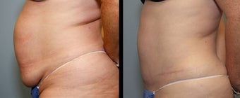 28 year old female- mini tummy tuck