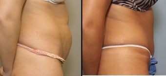 38 year old female with mini tummy tuck