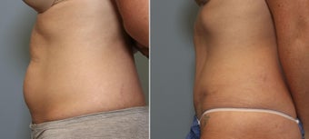 37 year old female with mini tummy tuck