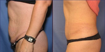 Mini Tummy Tuck