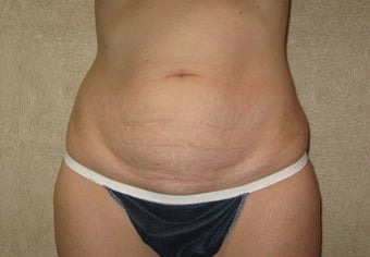 Abdominoplasty