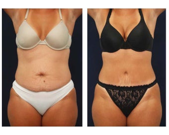 Tummy Tuck or Abdominoplasty