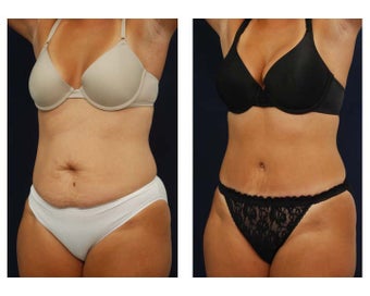 Tummy Tuck or Abdominoplasty