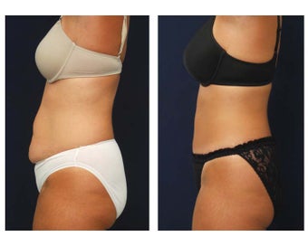 Tummy Tuck or Abdominoplasty