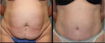 28 year old female- mini tummy tuck