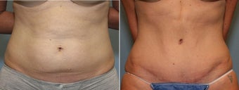 37 year old female with mini tummy tuck