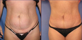 Mini Tummy Tuck