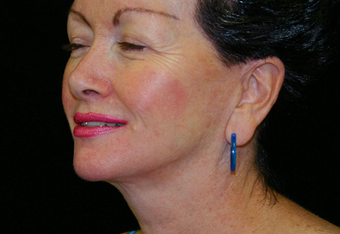 Facelift