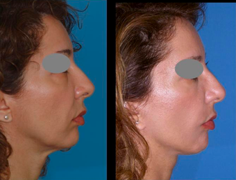 Mid-face (cheek) lift and mini-facelift