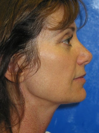 Mini Face lift