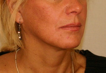 Mini Facelift (Mini lift)