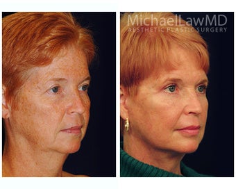 Facial Rejuvenation