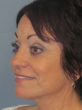 Lite Lift, Brow Lift