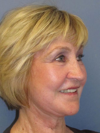 Lite Lift™, Eyelid lift, brow lift, Liposuction to chin