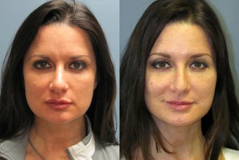 Lite Lift, Brow Lift