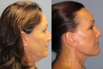 Lite Lift, Liposuction of the  neck