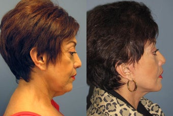 Lite Lift, neck lift, eyelid lift