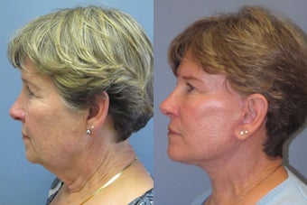 Lite lift, Neck Lift, Brow Lift